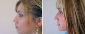rhinoplasty procedure