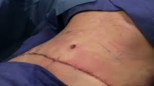 tummy tuck