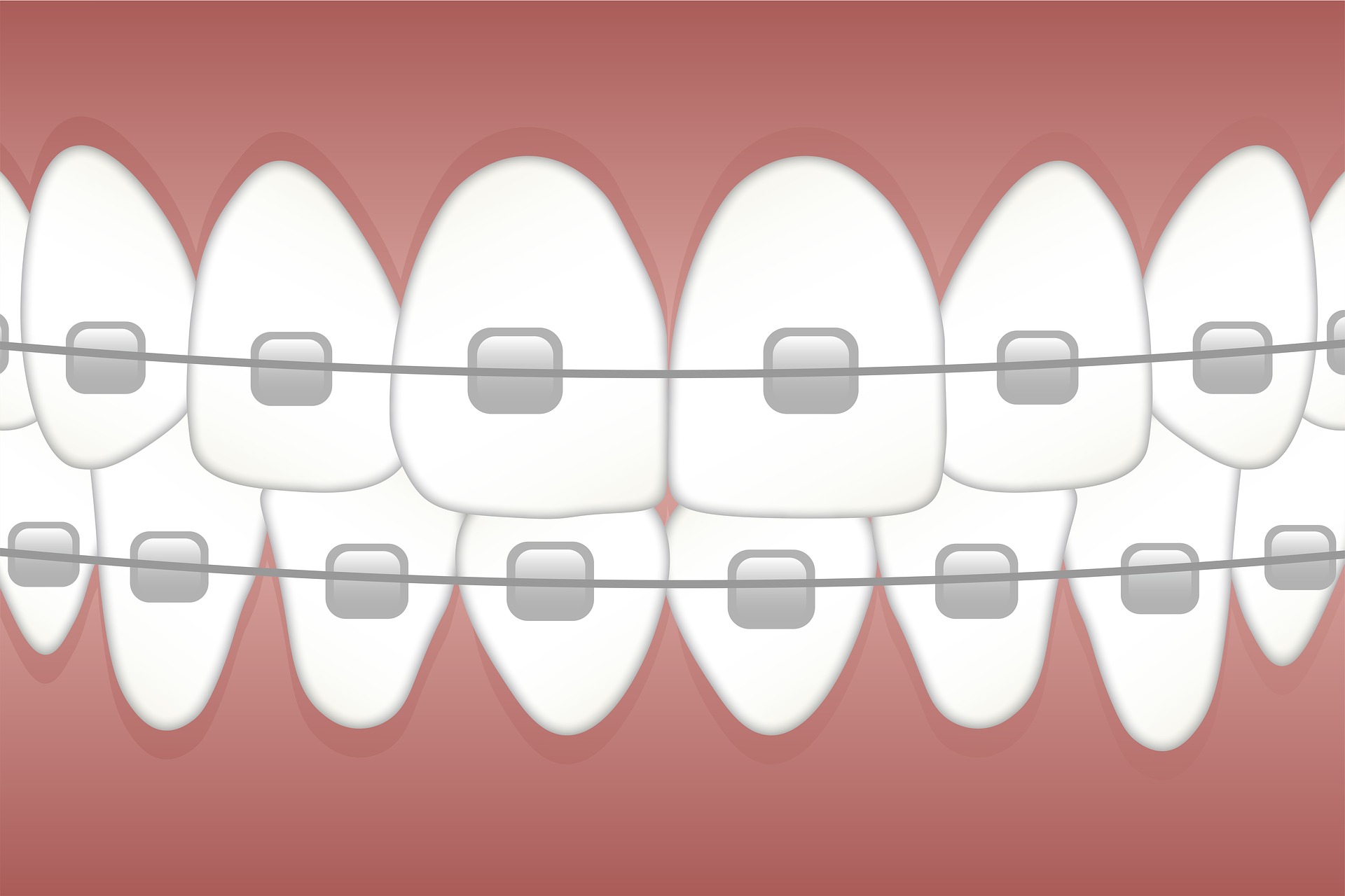 Unique Properties of Invisalign That Make It Advantageous
