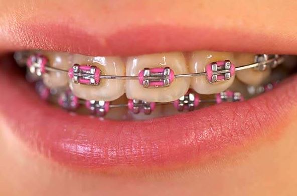 orthodontic treatment